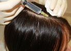 Мезотерапия – уколы против выпадения волос