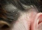 Причины шелушения кожи головы