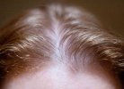 Почему происходит истончение волос у женщин?