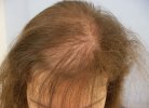 Влияние анемии на выпадение волос