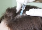 Почему после мезотерапии выпадают волосы?