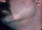 Алопеция на бороде у мужчин