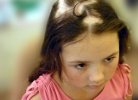 Лечение очаговой алопеции у детей