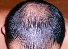 Cредства от выпадения волос у мужчин: народные и медицинские