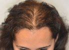 Диффузное выпадение волос у женщин
