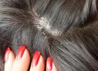 Себорея кожи головы и выпадение волос: методы лечения