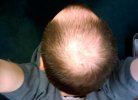 Выпадение волос на макушке: причины и методы борьбы