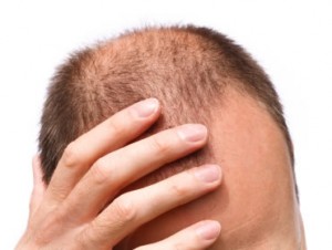 Диффузное выпадение волос