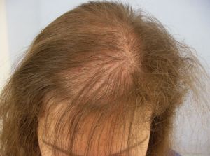 Анемия и выпадение волос