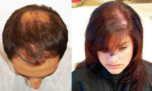Диффузное выпадение волос у женщин и мужчин