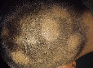 Гнездное выпадение волос