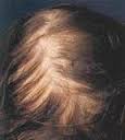 выпадение волос 