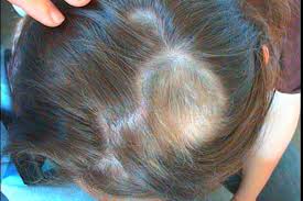 выпадение волос при гипотиреозе