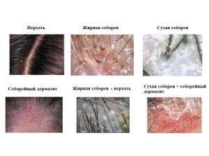 Виды себореи кожи головы